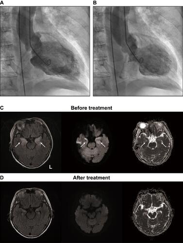 Figure 1 TTS following autoimmune limbic encephalitis. (A and B) Left ventriculographic findings. The diastole (A) and systole (B) images are shown. (C and D) MRI findings. The initial MRI (C) revealed abnormal hyperintense areas (arrows) in the bilateral medial temporal lobes on the fluid-attenuated inversion recovery image (left). Diffusion-weighted imaging (middle) and an apparent diffusion coefficient map (right) both revealed abnormal hyperintensity in these areas. The abnormalities were all resolved in follow-up MRI (D).