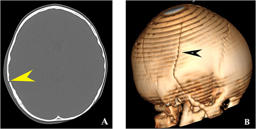 Figure 2 Axial NECT of a 2 year 7 months old girl who fell on the stairs. Right temporo-parietal fracture. (A) Axial NECT bone window shows linear right temporo-parietal fracture (Yellow pointed arrow). (B) VRT image of the skull with the fracture seen in the right temporo-parietal region (black pointed arrow).