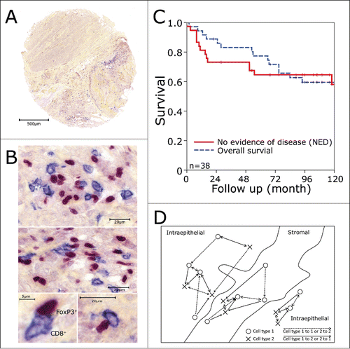 Figure 1. Tissue microarrays and immunohistochemistry. Biopsy specimens were processed into tissue microarrays using a core diameter of 1.6 mm. Tissue microarray tumor punches (A) were stained for FoxP3+ (red nucleic staining) and CD8+ (blue predominantly membranous staining) as shown in (B). (C) Kaplan–Meier plots for overall survival and no evidence of disease over the whole patients collective. (D) Schematic view on the counting strategy used with the image analysis system. The shortest distance to the next cell was calculated from cell type I to cell type I (dashed line) and from cell type I to cell type II and vice versa (continuous line). Only the cells marked with an arrow were calculated in reference to the other cell. Cells in stromal or intraepithelial compartment were analyzed separately.