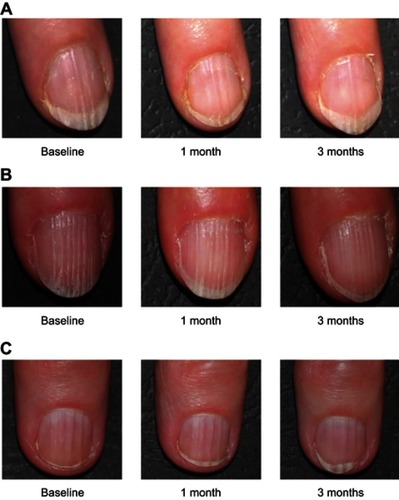 Figure 5 Clinical pictures showing the effect of the topical and/or oral biomineral formulation on nail roughness.