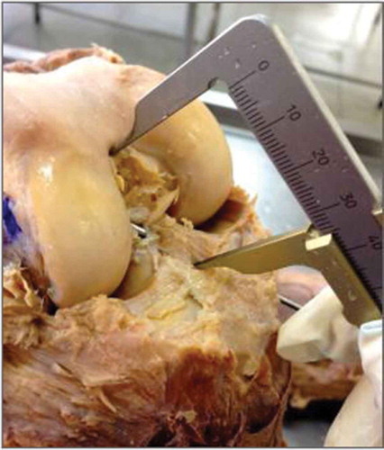 Figure 7. Height from the articular surface of the tibia to the intercondylar roof.Source: Anatomy Laboratory–UNIRIO, 2014–2015.