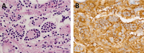 FIGURE 1. (A) Emperipolesis in Rosai-Dorfman disease: Large irregularly shaped histiocytes with abundant cytoplasm engulf intact cells, predominantly lymphocytes (H&E; 400×). (B) Cells that demonstrate emperipolesis are positive for S100 (S100; 400×).