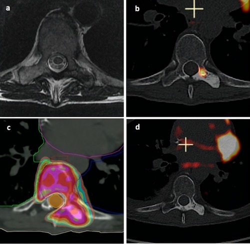 Figure 1 A 68 year old woman affected by metastatic breast cancer was referred for SBRT of a painful metastasis of the left transverse pedicle of the 8th thoracic vertebra.Notes: (A) MRI view prior to SBRT. (B) 18FDG-PET view prior to SBRT. (C) Dose planning prior to administration of a single fraction of 18 Gy to the 80% isodose line (color wash deep orange, light blue, yellow, gold, purple, red and olive corresponding respectively to 14, 15, 16, 17, 18, 19, 20 and 21 Gy), resulting in conformal dose distribution sparing the spinal canal (light orange). (D) 18FDG-PET view 6 months after SBRT, showing stable mineralization of the treated area and metabolic complete response. Acute toxicity consisted of G2 dysphagia due to proximity of the esophagus. No late toxicity was observed at 1 year, while complete pain control was obtained.