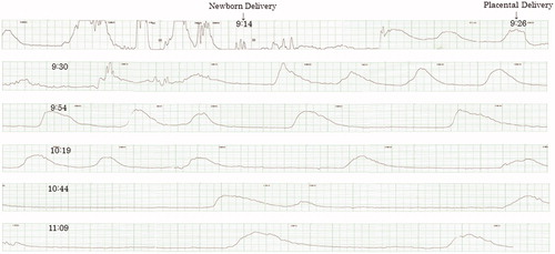 Figure 1. This 37-year-old multiparous woman exhibited good uterine contraction. The measured total blood loss was 261 g. The period within the first two hours after the delivery of the placenta showed a uterine contraction frequency that slightly decreased over time. The rate of paper feed was 3 cm/min.