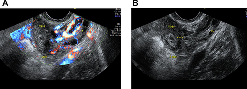 Figure 1 (A) Pelvic ultrasound of latest interstitial ectopic pregnancy (2022). (B) Pelvic ultrasound of latest interstitial ectopic pregnancy (2022).