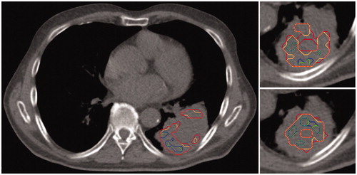 Figure 3. The HTVuptake based on either the aortic arch (orange) or muscle (green) as reference region in three representative slices, and the corresponding HTVpO2 with the highest overlap fractions in red for the aortic arch as reference, and in blue with the muscle as a reference. The figure appears in color in the online version of the article.