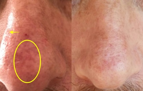 Figure 2 Patient at T0 (left) and T4 (right). Here we can notice the local inflammation has reduced (yellow circle), whilst the skin watermark has improved (yellow arrows).