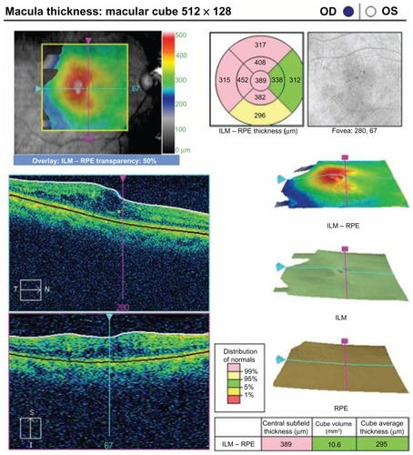 Figure 8 Optical coherence tomograph for the same patient in group 2 at the 12-month visit.