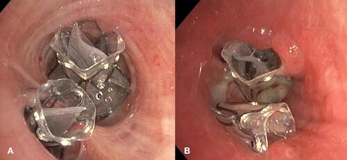 Figure 3 Endoscopic images of implanted valves in one patient. (A) Directly after implantation. (B) During revision bronchoscopy performed due to a loss of initial treatment effect. Granulation tissue has formed around the valves causing dislocation of the lower valve.