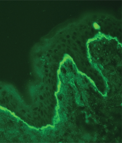 Figure 2 A sharply defined thin linear band at the dermoepidermal junction in pemphigoid (immunoglobulin class G deposits, original magnification:×200).