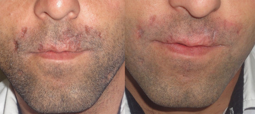 Figure 4 Clinical appearance of lesions at the end of the 6th (left) month of treatment, and after the second month after treatment (right).