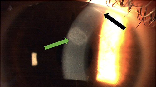 Figure 2 Slit lamp image of an epithelial ingrowth without a fistula to the incision after SMILE. Green arrow points to an epithelial ingrowth that was self-limiting, while the black arrow points to the incision and absent fistula.