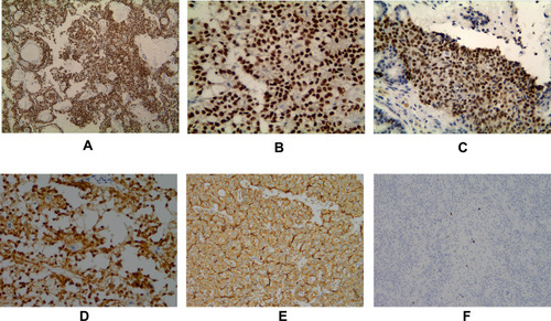 Figure 2 Immunohistochemical staining (EnVision Method). (A and B) LEF1 is positively expressed in the nucleus of the tumor cells at ×100 and ×400 magnification, respectively. (C) LEF1 is positively expressed in the nucleus of the pancreatoblastoma tumor cells (magnification, ×400). (D) β-catenin is positively expressed in the nucleus and cytoplasm of the tumor cells (magnification, ×400). (E) Vimentin is positively expressed in the cytoplasm of tumor cells (magnification, ×200). (F) Ki-67 proliferation index of the tumor cells is low, and the nucleus is positively expressed (magnification, ×200).