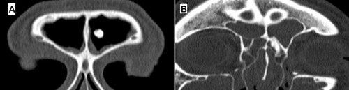 Figure 4 Comparison of frontal sinus CCAD (A) vs nonCCAD (B) features. Scale bar, 1 cm is equal to 5 cm.