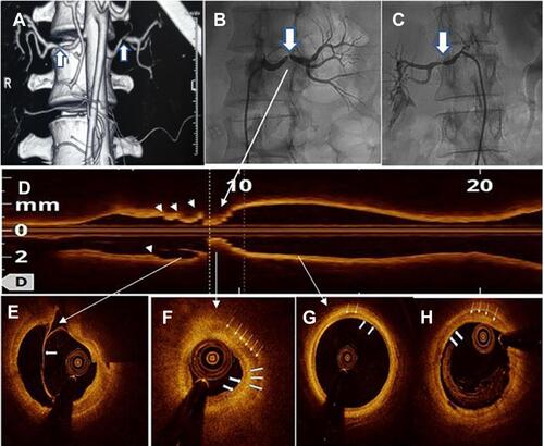 Figure 1 Various Imaging modalities used in diagnosing Renal artery stenosis in fibromuscular dysplasia.