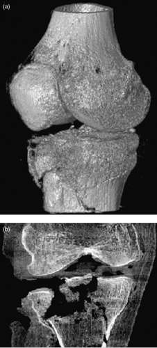 Figure 3. Case 1. (a) Example image illustrating uniform volumetric image quality and sub-millimetric spatial resolution across a fairly large field of view. (b) Example CBCT image (coronal view) demonstrating the fracture type before reduction. Note the amount of compression and the irregularity of the articular surface.