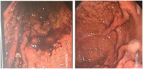 Figure 1. Upper endoscopic pictures of two patients on maintenance hemodialysis, showing intensely frail and red gastric mucus with serious nodular configuration.