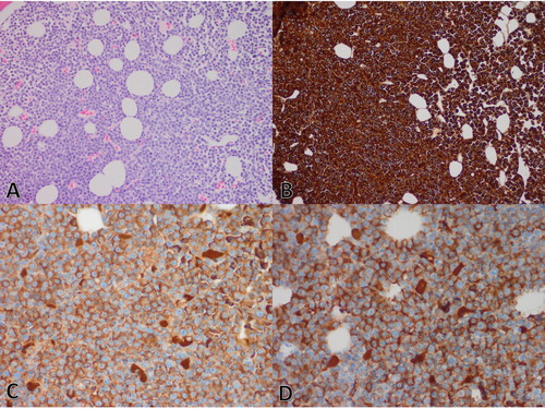 Figure 2. Representative photomicrographs of marrow trephine biopsy in Case 2: (A) H&E showing subtotal replacement of the cellular marrow by plasma cells (200×). (B) Immunohistochemistry for Lambda showing lambda-restriction (200×). (C) Immunohistochemistry for IgG and (D) IgG4 showing the majority of plasma cells staining positive for both IgG and IgG4 (400×). On-slide negative and positive controls showed appropriate staining pattern (images not shown).
