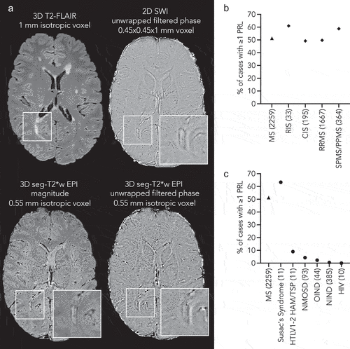 Figure 1. (A) Representative 3-tesla MRI example of a paramagnetic rim lesion (PRL) in a 21-year-old man with relapsing MS. PRL is clearly seen on both 3D seg-T2*-w EPI magnitude and unwrapped filtered phase images and on axial SWI phase images. For each image modality, PRL magnification is shown in the white insets. For each MRI sequence, image resolution is provided. (B) Graph showing the overall percentage of MS cases with at least one PRL by MS clinical phenotypes (number of cases evaluated in the brackets). (C) Graph showing the overall percentage of cases with at least one PRL by diseases (number of cases evaluated in the brackets).