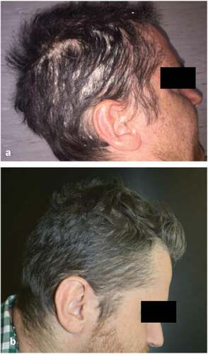 Figure 2. Severe scalp involvement before (a) and after 156 weeks (3 years) of treatment with secukinumab (b) in a patient affected by major depression.