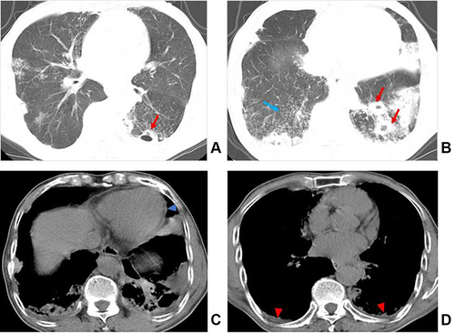 Figure 3 Multidrug-resistant pulmonary tuberculosis in a 77-year-old male patient. (A and B) Axial computed tomography images of the lung window indicate multiple thick-walled cavities (red arrow), consolidation, and centrilobular micronodules and tree-in-bud sign (blue arrow) in both lungs. (C and D) Axial computed tomography images of the mediastinal window indicate pericardial thickening (blue arrowhead) and bilateral pleural thickening (red arrowhead).