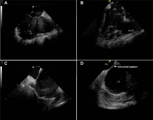 Figure 3 Real-time acquisition by intracardiac echocardiography.