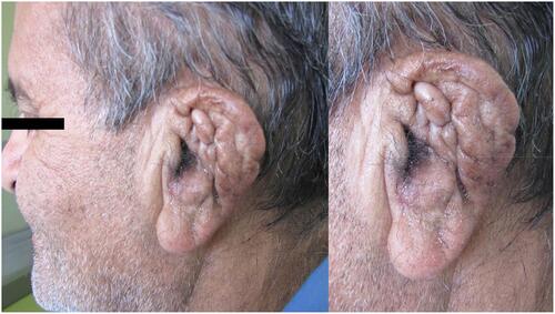 Figure 3 Left ear after surgical excision and antifungal therapy.