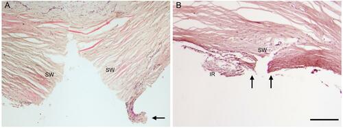 Figure 4 The anterior chamber angle following MVR goniotomy created an incision in the trabecular meshwork (TM) without removal of TM leaflets (arrows), through the Canal of Schlemm and passing to varying depths into the scleral wall (SW). In (A), the incision extended deep into the scleral wall and a visible ~200 µm remnant of TM is apparent (arrow). In (B) the incision extends just past the outer wall of the Canal of Schlemm, also showing no excision of TM (arrows). H&E stained section, scale bar = 200 µm.