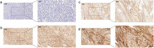 Figure 4. The protein expression levels of COL6A1 in our BC and normal tissues. Immunohistochemical staining results: a-normal tissue; b- positive staining; c-not metastatic tissues; d- distant metastasis tissues (antibody 17,023-1-AP, Proteintech Company, Chicago, USA).