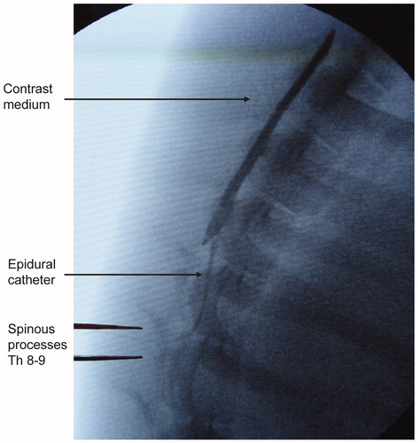 Figure 1. Initial phase of infusion of contrast medium into the epidural space.