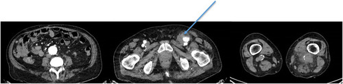 Figure 1 Axial section on computed tomography images. Arrow shows left common femoral artery aneurysm.