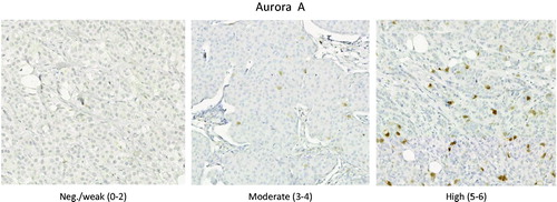 Figure 1. Representative pictures showing immunohistochemical staining for Aurora A: negative/weak, moderate and high staining.