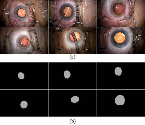 Figure 3 Samples in the anterior capsulotomy classification dataset. (a) The Capsulotomy images and (b) its corresponding capsulotomy masks.