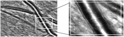 Figure 4. Automatic measurement of retinal arteriole structures by adaptive optics rtx1. Left image: selection of vessel part for analysis; right image: enlarged area of measurement with marked part of directly measured arteriolar wall thickness, inner- and outer diameters. WLR and WCSA are calculated by integrated software. The measurement was taken from right eye temporal superior to optic nerve of 35years old woman with normal blood pressure without arterial hypertension therapy (by J.M.H.).