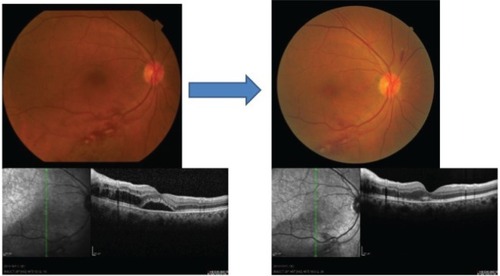 Figure 3 Case three: fundus and optical coherence tomographic images of a 71-year-old man with a BRVO before and after treatment of systemic hypertension with angiotensin receptor blocker.