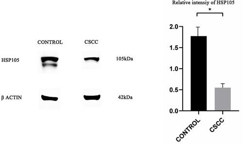 Figure 2 Western blot analysis of HSP105 expression in CSCC and controls (normal skin). The comparison is shown in the column graph. Values represent the mean ± SD. *, P < 0.05.