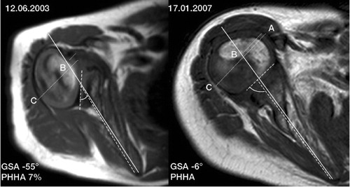 Figure 3. Axial T1-W images of the right glenohumeral joint of a boy with BPBI-related restricted external rotation. Relocation operation performed at the age of 4 years. a) Preoperatively: pseudoglenoid with severe retroversion of the right glenoid fossa, GSA = -55°; PHHA = 7% at the age of 3 years and 4 months. b) Postoperatively: glenohumeral joint with GSA = -6° and PHHA = 40% at the age of 7 years.