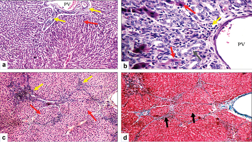 Figure 8. Histopathologic features of liver sections from bile duct ligated-selenium group. (a) Section stained with hematoxylin and eosin (H&E) shows portal tract with dilated portal vein (PV), mild portal inflammatory infiltrate (yellow arrows) and average hepatocytes (red arrow) (X200). (b) Higher magnification of the previous section shows dilated PV, proliferating bile ducts with average epithelial lining (grey arrow), mild portal inflammatory infiltrate (yellow arrow), and scattered apoptotic hepatocytes in the interface area (red arrows) (H&E, X400). (c) Another section shows an expanded portal tract with mild portal inflammatory infiltrate (yellow arrows), and mild fibrosis with architectural distortion (red arrows) (H&E, X200). (d) Masson trichrome stained section from the same group shows mild fibrosis with architectural distortion (black arrows) (X200).