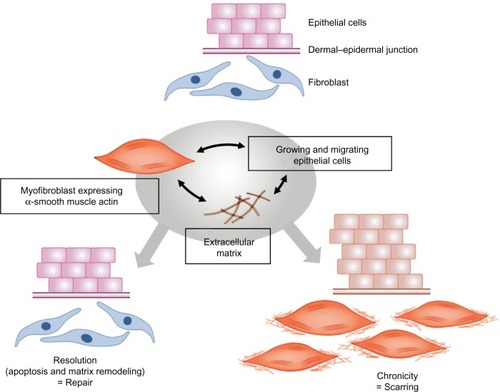 Figure 4 Processes leading to normal wound repair and pathological scarring.