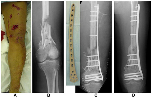 Figure 5 Case of a 42 year-old patient who was treated with an iodine-coated internal fixation plate.