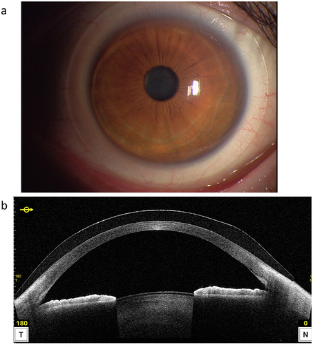 Figure 1 Slit-lamp biomicroscopy photograph and anterior segment optical coherence tomography image in an eye wearing YOUSOFT contact lens. (a and b) show a representative slit-lamp biomicroscopy photograph and an anterior segment optical coherence tomography image in an eye wearing a YOUSOFT contact lens, respectively.