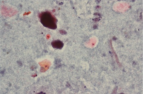 Figure 1 Urothelial cells suspicious for urothelial carcinoma, normal urothelial cells, and bacterial colonization (Papanicolaou stain, 200×).