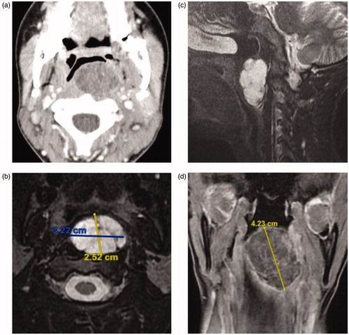 Figure 1. (a) Contrast-enhanced CT scan of the neck shows a large well-circumscribed left retropharyngeal mass lesion protruding into the oropharynx. The lesion is remodeling the adjacent vertebral body, without bony erosion or intraspinal extension. (b, c) Axial and sagittal T2-weighted MRI of the neck demonstrate a heterogeneously hyperintense mass with low signal intensity internal septations. The overlying pharyngeal mucosa is intact and no cervical lymphadenopathy is seen. (d) Coronal contrast-enhanced T1-weighted MRI shows peripheral enhancement of the left retropharyngeal mass, as well as enhancement of the internal septations.