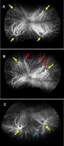 Figure 1 Ultra-widefield Indocyanine green angiography images depicting the presence of multiple vortex veins (yellow arrows) in a central frame (A). Superior steered (red arrows, B); and inferior steered (blue arrow, C) images revealing the presence of additional vortex veins in the same eye.