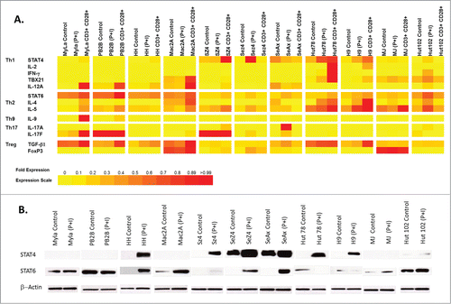 Figure 1. (A) Correlation of STAT4 and STAT6 expression with different T helper phenotype markers in CTCL cell lines under normal control vs. T cell stimulation culturing conditions (e.g., 10 ng/mL of PMA (phorbol 12-myristate 13-acetate) and 1 (M of ionomycin or with CD3/CD28 Dynabeads®). (B) Western blot analysis of STAT4 and STAT6 expression in patient-derived CTCL cell lines under normal control vs. T cell stimulation culturing conditions (i.e., PMA and ionomycin)