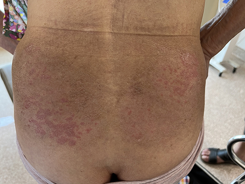 Figure 4 Topical calcipotriol and betamethasone ointment was applied to the psoriasis-like lesions.