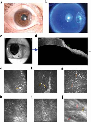Figure 1. The clinical characteristics from examinations of the patient’s right eye. (a) Slit-lamp microscopy examination. A pterygium in the nasal interpalpebral zone and a ring-shaped peripheral corneal ulcer with an infiltrated, overhanging edge along the head of the pterygium. (b) Fluorescein staining shows ring-shaped thinning of the peripheral cornea with infiltration and epithelial defects in the lesions with no obvious secretions. (c-d) AS-OCT showing corneal stromal lysis thinning. (b) thinnest point of the lesion measures 212 μm. (blue arrow) (e-g) IVCM examination. (e-f) revealed a marked inflammatory cell infiltration with epithelial cell detachment in the lesion area (yellow arrows), (g) a larger number of Langerhans cells (orange arrows), (h) has stromal exposure and loose structure, (i) a small number of infiltrating inflammatory cells and (j) shows deep stromal (keratocytes) densification and scar formation (light orange arrow), and invasion of new blood vessels (red arrows).