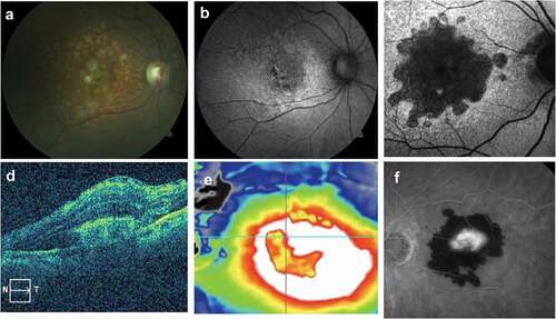 Figure 1. Multimodal imaging of different stages of age-related macular degeneration. (a) Color fundus photo of drusen stage dry macular degeneration of a patient whose best corrected visual acuity (BCVA) is 20/20. (b) Fundus autof luorescence (FAF) of same patient demonstrating the start of GA not visible on the fundus photo. (c) FAF of patient with extensive GA with a (BCVA) of 20/200. (d) Spectral domain optical coherence tomogram (SDOCT) cross sectional image of patient presenting with exudative AMD. (e) SDOCT topographic view of same patient where white represents elevation >400 UM and normal would be green (250 um). (f) Fluorescein angiogram of same patient showing central leakage and a ring of subretinal hemorrhage. This patient would not qualify for any clinical trial for exudative AMD.