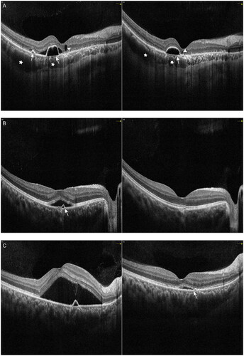 Figure 3. Examples of the change in pigment epithelial detachment (PED) with spectral domain optical coherence tomography (SD-OCT) in patients with chronic central serous chorioretinopathy (cCSC) after intravitreal injections with aflibercept (IVA). The left panel represents SD-OCT B-scan images at baseline visit, the right panel represents SD-OCT B-scan images at one-month follow-up visit after IVA. (A) SD-OCT scan at baseline from the right eye of the patient depicted in Figure 1 (left). At the one-month visit after IVA treatment, subretinal fluid (SRF) was completely absorbed, small PED in the temporal macula was resolved. The large dome-shaped PED height remained relatively stable and small posterior cystoid retinal degeneration and dilated choroidal vessels were visible (right). (B) SD-OCT B-scan at baseline showed sub-macular SRF and a small PED from the right eye of a 31-year-old female patient (left). Presence of RPE micro-rip at the peak of PED was visible (arrow). At the one-month visit, SRF as well as PED were resolved, undulating RPE was visible subfoveally (right). (C) SD-OCT B-scan at baseline showed sub-macular SRF and a small PED from the right eye of a 44-year-old male patient (left). At the one-month visit (right), SRF was partially absorbed, small PED was resolved, a discontinuous RPE was visible, likely representing the leakage spot in RPE (arrow).