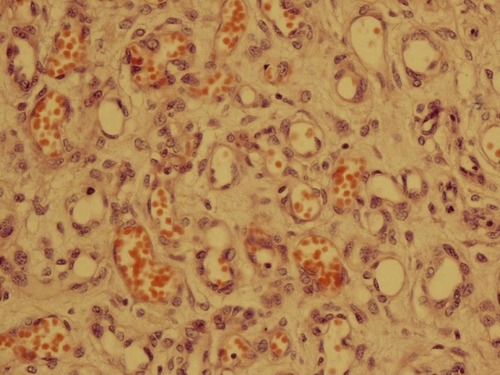 Figure 4 Numerous capillary sized vascular channels (H&E × 40).